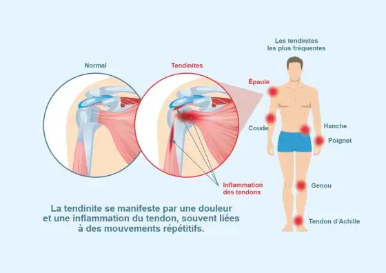 Tendinite - les gestes qui protègent vraiment vos tendons